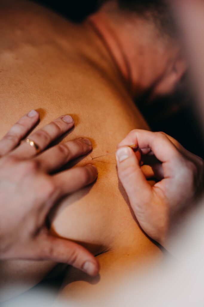 Kinesist Destelbergen Dry needling bij schouderpijn behandelen